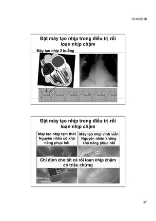 13/10/2016
37
Đặt máy tạo nhịp trong điều trị rối
loạn nhịp chậm
Máy tạo nhịp 2 buồng
Máy tạo nhịp tạm thời
Nguyên nhân có khả
năng phục hồi
Máy tạo nhịp vĩnh viễn
Nguyên nhân không
khả năng phục hồi
Đặt máy tạo nhịp trong điều trị rối
loạn nhịp chậm
Chỉ định cho tất cả rối loạn nhịp chậm
có triệu chứng
 