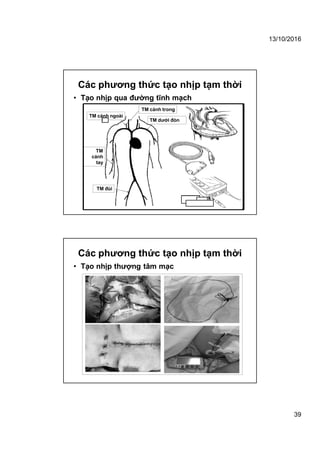 13/10/2016
39
Các phương thức tạo nhịp tạm thời
• Tạo nhịp qua đường tĩnh mạch
TM cảnh ngoài
TM cảnh trong
TM dưới đòn
TM
cánh
tay
TM đùi
Các phương thức tạo nhịp tạm thời
• Tạo nhịp thượng tâm mạc
 
