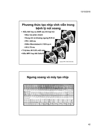 13/10/2016
42
Phương thức tạo nhịp vĩnh viễn trong
bệnh lý nút xoang
Lancet 1997; 350:1210-1216.
 Kiểu AAI hay ou AAIR sau khi loại trừ:
 Bloc hai phân nhánh
 Rung nhĩ và khoảng ngưng R-R trên 3s
 PR > 220 ms
 Điểm Wenckebach ≤ 120 b.p.m
 HV ≥ 70 ms
 Tỉ lệ bloc AV 0.6% mỗi năm
 Kiểu MPV hay AAI Safe-R
Ngưng xoang và máy tạo nhịp
 