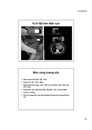 13/10/2016
53
Vị trí đặt bản điện cực
 Nhịp nhanh trên thất: 100 - 150J
 Rung nhĩ: 100 – 150 – 200J.
 Nhanh thất đơn dạng: 120 – 150J với sốc điện 2 pha. 200J nếu
sốc 1 pha
 Rung thất: sốc 2 pha khởi đầu 150-200J . Sốc 1 pha là 360J.
 Trẻ em: 1-2J/kg
 Phụ nữ mang thai: sốc điện 50-300J không ảnh hưởng tới thai
nhi.
Mức năng lượng sốc
 