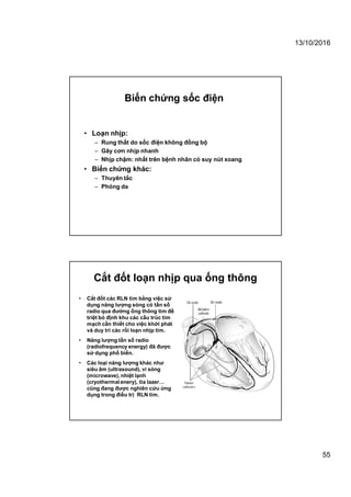 13/10/2016
55
• Loạn nhịp:
– Rung thất do sốc điện không đồng bộ
– Gây cơn nhịp nhanh
– Nhịp chậm: nhất trên bệnh nhân có suy nút xoang
• Biến chứng khác:
– Thuyên tắc
– Phỏng da
Biến chứng sốc điện
Cắt đốt loạn nhịp qua ống thông
• Cắt đốt các RLN tim bằng việc sử
dụng năng lượng sóng có tần số
radio qua đường ống thông tim để
triệt bỏ định khu các cấu trúc tim
mạch cần thiết cho việc khởi phát
và duy trì các rối loạn nhịp tim.
• Năng lượng tần số radio
(radiofrequency energy) đã được
sử dụng phổ biến.
• Các loại năng lượng khác như
siêu âm (ultrasound), vi sóng
(microwave), nhiệt lạnh
(cryothermalenery), tia lazer…
cũng đang được nghiên cứu ứng
dụng trong điều trị RLN tim.
 