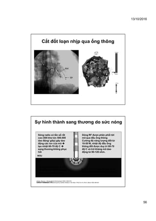 13/10/2016
56
Cắt đốt loạn nhịp qua ống thông
Lesion Science 112
Sự hình thành sang thương do sức nóng
Dòng RF được phân phối tới
mô qua đầu ống thông
Cường độ năng lượng đốt từ
10-50 W, nhiệt độ đầu ống
thông đốt được duy trì 60-70
độ C và trở kháng mô dao
động từ 80-120 ohm.
Do mô có trở kháng rất cao, dòng
điện đi qua tạo sức nóng trong mô
Haines, DE et. al. : Pacing Clinical Electrophysiol 1989 12:962-976
Haines D. The Biophysics of Radiofrequency Catheter Ablation in the Heart. PACE Vol 16, Part II, March 1993;586-591
MÁU
MÔ
Sóng radio có tần số rất
cao (500 khz tức 500.000
dao động/ giây) gây dao
động các ion của mô 
tạo nhiệt 60-70 độ C 
sang thương không phục
hồi
Sang thương tạo ra có
đường kình 5=10 mm và
sâu vài mm (1-2 mm)
 