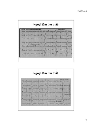 13/10/2016
6
Ngoại tâm thu thất
Ngoại tâm thu thất
 
