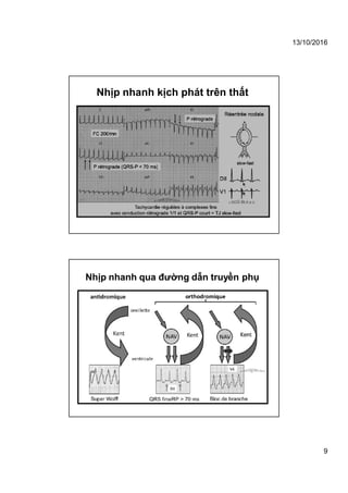 13/10/2016
9
Nhịp nhanh kịch phát trên thất
Nhịp nhanh qua đường dẫn truyền phụ
 