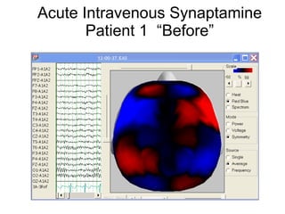 Acute Intravenous Synaptamine Patient 1  “Before” 