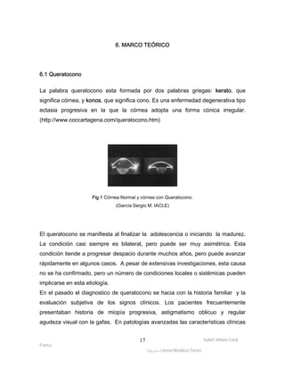 Isabel Johana Coral 
Franco 
6. MARCO TEÓRICO 
ltéÅ|Üt Lorena Mendoza Forero 
17 
6.1 Queratocono 
La palabra queratocono esta formada por dos palabras griegas: kerato, que 
significa córnea, y konos, que significa cono. Es una enfermedad degenerativa tipo 
ectasia progresiva en la que la córnea adopta una forma cónica irregular. 
(http://www.coccartagena.com/queratocono.htm) 
Fig.1 Córnea Normal y córnea con Queratocono. 
(García Sergio M. IACLE) 
El queratocono se manifiesta al finalizar la adolescencia o iniciando la madurez. 
La condición casi siempre es bilateral, pero puede ser muy asimétrica. Esta 
condición tiende a progresar despacio durante muchos años, pero puede avanzar 
rápidamente en algunos casos. A pesar de extensivas investigaciones, esta causa 
no se ha confirmado, pero un número de condiciones locales o sistémicas pueden 
implicarse en esta etiología. 
En el pasado el diagnostico de queratocono se hacia con la historia familiar y la 
evaluación subjetiva de los signos clínicos. Los pacientes frecuentemente 
presentaban historia de miopía progresiva, astigmatismo oblicuo y regular 
agudeza visual con la gafas. En patologías avanzadas las características clínicas 
 