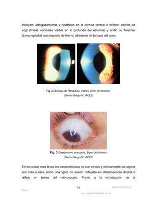 incluyen: adelgazamiento y cicatrices en la córnea central e inferior, estrías de 
vogt (líneas verticales visible en lo profundo del estroma) y anillo de fleischer 
(Línea epitelial con deposito de hierro) alrededor de la base del cono. 
En los casos más leves las características no son obvias y clínicamente los signos 
son mas sutiles, como una “gota de aceite” reflejado en oftalmoscopia directa o 
reflejo en tijeras del retinoscopio. Previo a la introducción de la 
Isabel Johana Coral 
Franco 
Fig. 2 Lámpara de Hendidura, estrías, anillo de fleischer. 
(García Sergio M. IACLE) 
Fig. 3 Queratocono avanzado. Signo de Munson. 
(García Sergio M. IACLE) 
ltéÅ|Üt Lorena Mendoza Forero 
18 
 