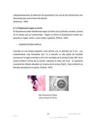 videoqueratoscopía, la detección de queratocono fue una de las indicaciones mas 
frecuentes para usar el disco de placido. 
(Krachmer, 1984) 
6.1.2 Clasificación según su forma 
El Queratocono debe identificarse según la forma de la profusión corneal y el área 
de la córnea que se compromete. Según su forma el Queratocono puede ser: 
pequeño o nipple, medio u oval, amplio o globoso. (Patrick, 1997) 
Isabel Johana Coral 
Franco 
ltéÅ|Üt Lorena Mendoza Forero 
19 
- QUERATOCONO NIPPLE. 
Consiste en una ectasia pequeña, zona central, con un diámetro de 5 mm. Las 
características más frecuentes son: 1) a menudo un alto grado de toricidad 
corneal con la regla confinado a los 5 mm centrales de la córnea 2) casi 360° de la 
media periferia normal de la córnea rodeando la base del cono 3) presencia 
ocasional de nódulos elevados en el ápice de la córnea (Fig.6). Esta condición es 
llamada queratocono en pezón. (Patrick, 1997) 
Fig. 4 Queratocono Nipple. 
(García Sergio M. IACLE) 
 