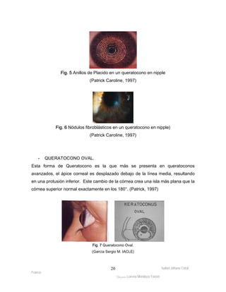 Fig. 5 Anillos de Placido en un queratocono en nipple 
Fig. 6 Nódulos fibroblásticos en un queratocono en nipple) 
Isabel Johana Coral 
Franco 
(Patrick Caroline, 1997) 
(Patrick Caroline, 1997) 
ltéÅ|Üt Lorena Mendoza Forero 
20 
- QUERATOCONO OVAL. 
Esta forma de Queratocono es la que más se presenta en queratoconos 
avanzados, el ápice corneal es desplazado debajo de la línea media, resultando 
en una protusión inferior. Este cambio de la córnea crea una isla más plana que la 
córnea superior normal exactamente en los 180°. (Patrick, 1997) 
Fig. 7 Queratocono Oval. 
(García Sergio M. IACLE) 
 