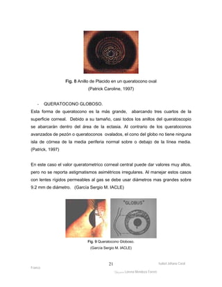 Isabel Johana Coral 
Franco 
Fig. 8 Anillo de Placido en un queratocono oval 
(Patrick Caroline, 1997) 
ltéÅ|Üt Lorena Mendoza Forero 
21 
- QUERATOCONO GLOBOSO. 
Esta forma de queratocono es la más grande, abarcando tres cuartos de la 
superficie corneal. Debido a su tamaño, casi todos los anillos del queratoscopio 
se abarcarán dentro del área de la ectasia. Al contrario de los queratoconos 
avanzados de pezón o queratoconos ovalados, el cono del globo no tiene ninguna 
isla de córnea de la media periferia normal sobre o debajo de la línea media. 
(Patrick, 1997) 
En este caso el valor queratometrico corneal central puede dar valores muy altos, 
pero no se reporta astigmatismos asimétricos irregulares. Al manejar estos casos 
con lentes rígidos permeables al gas se debe usar diámetros mas grandes sobre 
9.2 mm de diámetro. (García Sergio M. IACLE) 
Fig. 9 Queratocono Globoso. 
(García Sergio M. IACLE) 
 