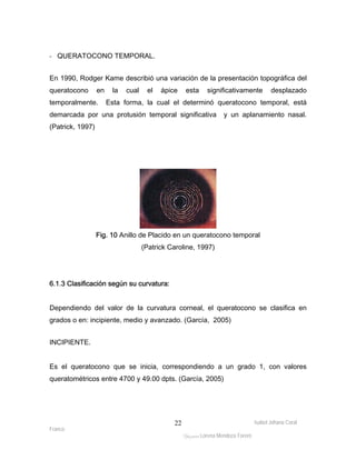 Isabel Johana Coral 
Franco 
ltéÅ|Üt Lorena Mendoza Forero 
22 
- QUERATOCONO TEMPORAL. 
En 1990, Rodger Kame describió una variación de la presentación topográfica del 
queratocono en la cual el ápice esta significativamente desplazado 
temporalmente. Esta forma, la cual el determinó queratocono temporal, está 
demarcada por una protusión temporal significativa y un aplanamiento nasal. 
(Patrick, 1997) 
Fig. 10 Anillo de Placido en un queratocono temporal 
(Patrick Caroline, 1997) 
6.1.3 Clasificación según su curvatura: 
Dependiendo del valor de la curvatura corneal, el queratocono se clasifica en 
grados o en: incipiente, medio y avanzado. (García, 2005) 
INCIPIENTE. 
Es el queratocono que se inicia, correspondiendo a un grado 1, con valores 
queratométricos entre 4700 y 49.00 dpts. (García, 2005) 
 