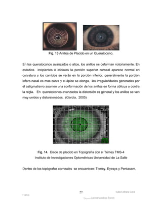 En los queratoconos avanzados o altos, los anillos se deforman notoriamente. En 
estadios incipientes o iniciales la porción superior corneal aparece normal en 
curvatura y los cambios se verán en la porción inferior, generalmente la porción 
infero-nasal es mas curva y el ápice se elonga, las irregularidades generadas por 
el astigmatismo asumen una conformación de los anillos en forma oblicua o contra 
la regla. En queratoconos avanzados la distorsión es general y los anillos se ven 
muy unidos y distorsionados. (García, 2005) 
Fig. 14. Disco de placido en Topografía con el Tomey TMS-4 
Instituto de Investigaciones Optométricas Universidad de La Salle 
Dentro de los topógrafos corneales se encuentran: Tomey, Eyesys y Pentacam. 
Isabel Johana Coral 
Franco 
Fig. 13 Anillos de Placido en un Queratocono. 
ltéÅ|Üt Lorena Mendoza Forero 
27 
 