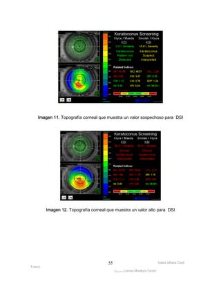 Imagen 11. Topografía corneal que muestra un valor sospechoso para DSI 
Imagen 12. Topografía corneal que muestra un valor alto para DSI 
Isabel Johana Coral 
Franco 
ltéÅ|Üt Lorena Mendoza Forero 
55 
 