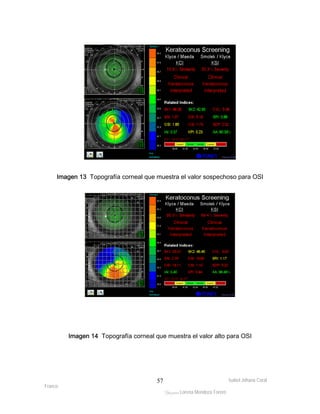 Imagen 13 Topografía corneal que muestra el valor sospechoso para OSI 
Imagen 14 Topografía corneal que muestra el valor alto para OSI 
Isabel Johana Coral 
Franco 
ltéÅ|Üt Lorena Mendoza Forero 
57 
 