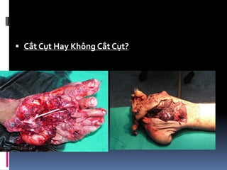  Cắt Cụt Hay Không Cắt Cụt?
 