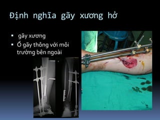 Định nghĩa gãy xương hở
 gãy xương
 Ổ gãy thông với môi
trường bên ngoài
 