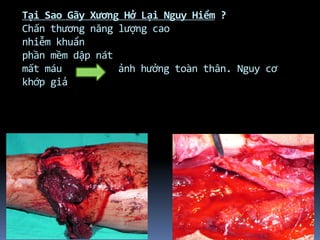 Tại Sao Gãy Xương Hở Lại Nguy Hiểm ?
Chấn thương năng lượng cao
nhiễm khuẩn
phần mềm dập nát
mất máu ảnh hưởng toàn thân. Nguy cơ
khớp giả
 