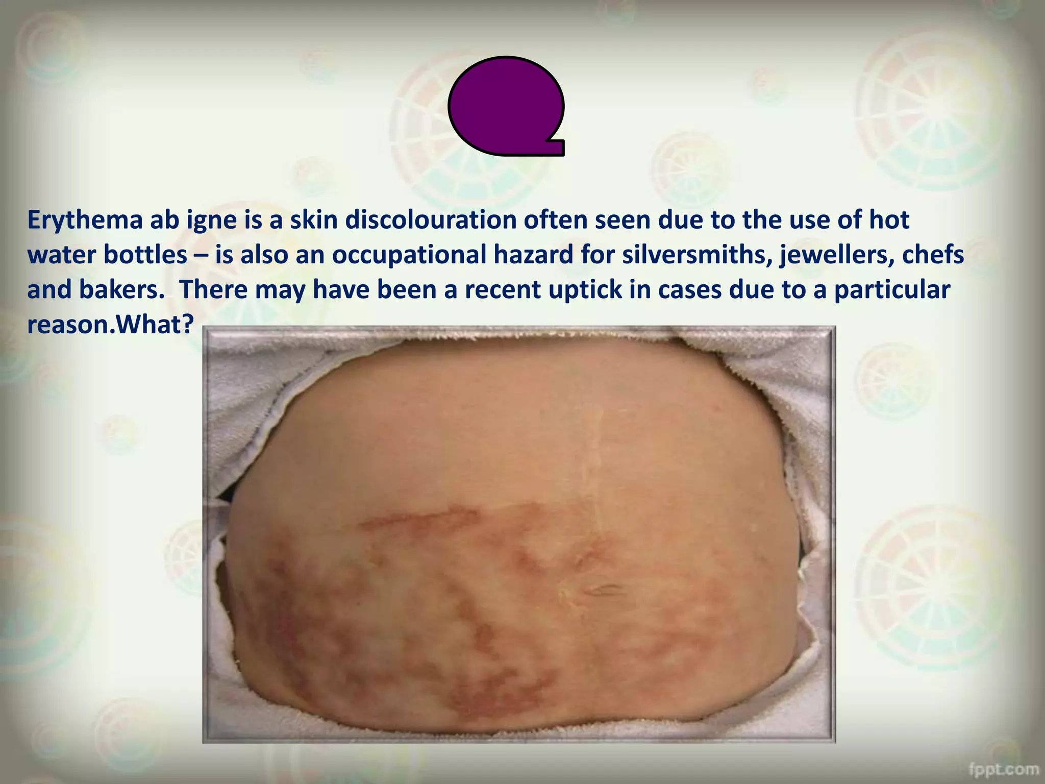 Erythema ab igne is a skin discolouration often seen due to the use of hot
water bottles – is also an occupational hazard for silversmiths, jewellers, chefs
and bakers. There may have been a recent uptick in cases due to a particular
reason.What?
 