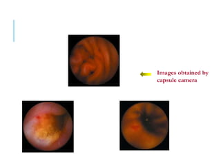 Images obtained by
capsule camera
 