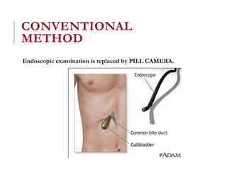 CONVENTIONAL
METHOD
Endoscopic examination is replaced by PILL CAMERA.
 