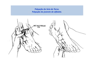 Palpação do Seio do Tarso.
Palpação do joanete de alfaiate.
 