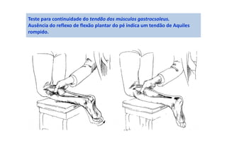 Teste para continuidade do tendão dos músculos gastrocsoleus.
Ausência do reflexo de flexão plantar do pé indica um tendão de Aquiles
rompido.
 