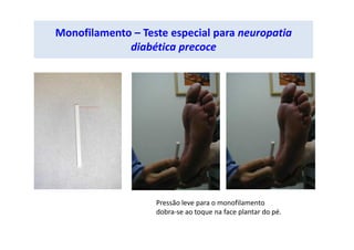 Monofilamento – Teste especial para neuropatia
diabética precoce
Pressão leve para o monofilamento
dobra-se ao toque na face plantar do pé.
 