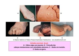 Achados anormais do pé.
A – Hálux valgo com joanete. B – Protusão das
cabeças metatarsianas com calosidades plantares. C – Dedos em martelo.
E- Dedos em garra.
 