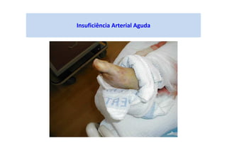 Insuficiência Arterial Aguda
 