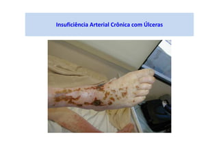 Insuficiência Arterial Crônica com Úlceras
 