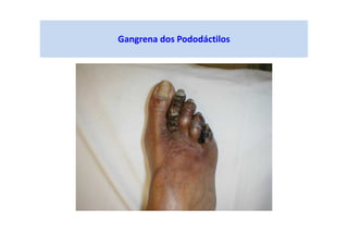 Gangrena dos Pododáctilos
 