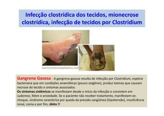 Infecção clostrídica dos tecidos, mionecrose
clostrídica, infecção de tecidos por Clostridium
Gangrena Gasosa - A gangrena gasosa resulta de infecção por Clostridium, espécie
bacteriana que em condições anaeróbicas (pouco oxigênio), produz toxinas que causam
necrose do tecido e sintomas associados.
Os sintomas sistêmicos se manifestam desde o início da infecção e consistem em
sudorese, febre e ansiedade. Se o paciente não receber tratamento, manifestam-se:
choque, síndrome caracteriza por queda da pressão sangüínea (hipotensão), insuficiência
renal, coma e por fim, óbito !!
 