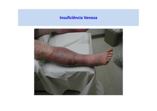 Insuficiência Venosa
 