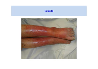 Celulite
 