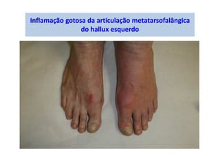 Inflamação gotosa da articulação metatarsofalângica
do hallux esquerdo
 