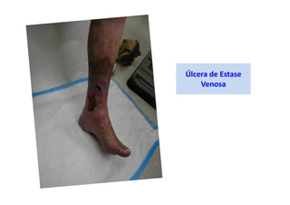Úlcera de Estase
Venosa
 