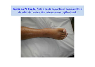 Edema do Pé Direito. Note a perda do contorno dos maléolos e
da saliência dos tendões extensores na região dorsal.
 