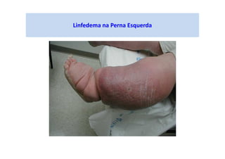 Linfedema na Perna Esquerda
 