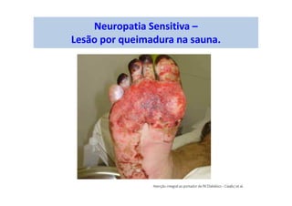 Neuropatia Sensitiva –
Lesão por queimadura na sauna.
 
