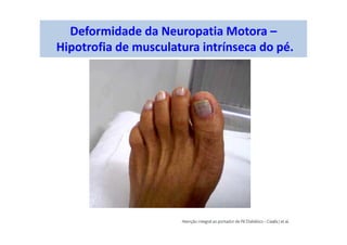 Deformidade da Neuropatia Motora –
Hipotrofia de musculatura intrínseca do pé.
 