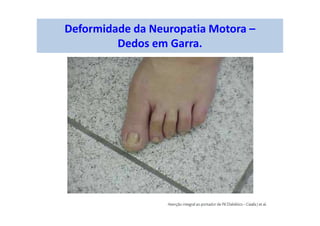 Deformidade da Neuropatia Motora –
Dedos em Garra.
 