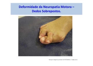 Deformidade da Neuropatia Motora –
Dedos Sobrepostos.
 
