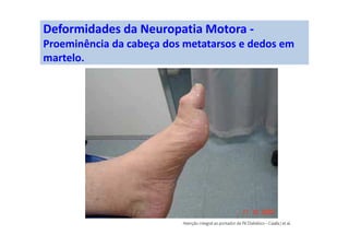 Deformidades da Neuropatia Motora -
Proeminência da cabeça dos metatarsos e dedos em
martelo.
 