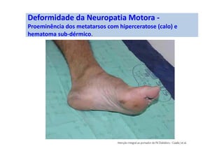 Deformidade da Neuropatia Motora -
Proeminência dos metatarsos com hiperceratose (calo) e
hematoma sub-dérmico.
 
