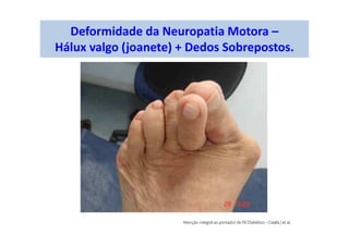 Deformidade da Neuropatia Motora –
Hálux valgo (joanete) + Dedos Sobrepostos.
 