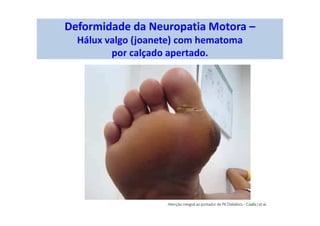 Deformidade da Neuropatia Motora –
Hálux valgo (joanete) com hematoma
por calçado apertado.
 