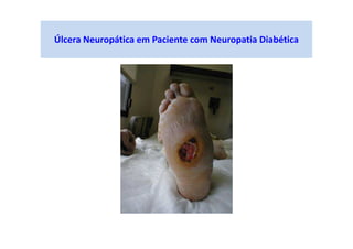 Úlcera Neuropática em Paciente com Neuropatia Diabética
 