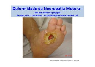 Deformidade da Neuropatia Motora -
Mal perfurante na projeção
da cabeça do 1º metatarso com grande hiperceratose perilesional.
 
