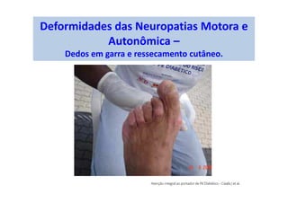 Deformidades das Neuropatias Motora e
Autonômica –
Dedos em garra e ressecamento cutâneo.
 