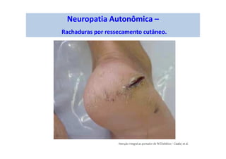 Neuropatia Autonômica –
Rachaduras por ressecamento cutâneo.
 